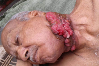 Carcinoma of Left