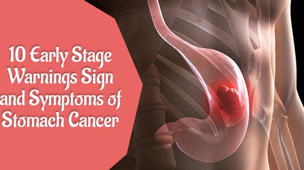 10 Early Stage warnings Sign and Symptoms of Stomach Cancer