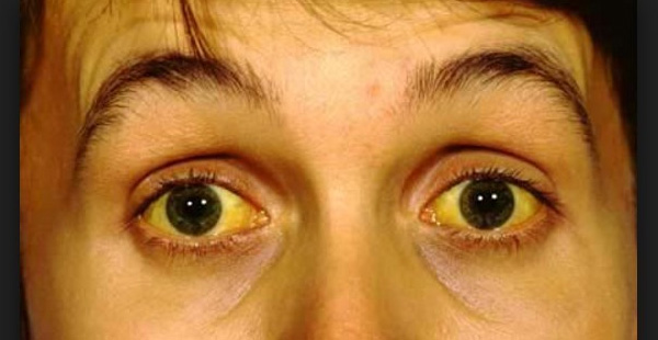 Jaundice - 8th Early sign and symptoms of stomach cancer