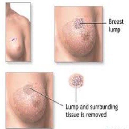 Breast cancer signs and symptoms