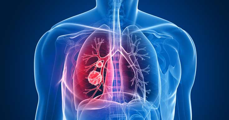 Lung Cancer causes, symptoms, stages