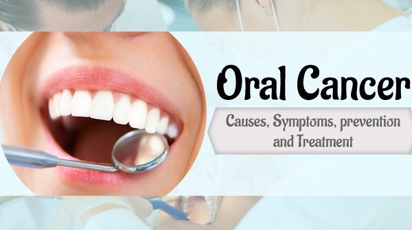 Signs and Symptoms of Oral Cancer