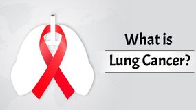 What is Lung Cancer? Survival Rate, Causes, Stages, Diagnosis & Treatment