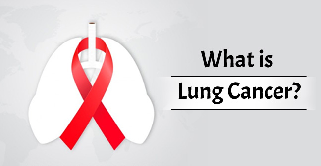 What is Lung Cancer? Survival Rate, Causes, Stages, Diagnosis & Treatment