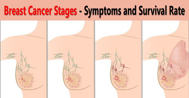 Breast Cancer Stages- Symptoms and Survival Rate