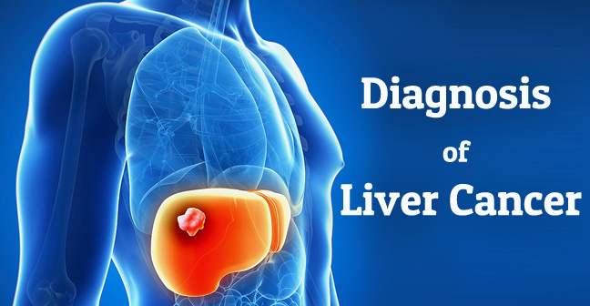 Liver Cancer Diagnosis and Symptoms