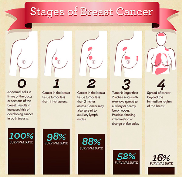 different stages of breast cancer