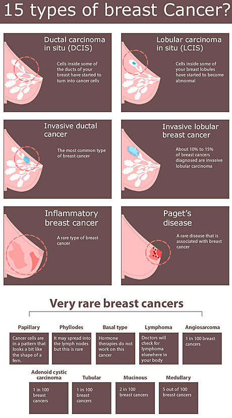 types of Breast Cancer- infographics