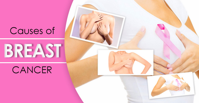 What are the Causes of Breast Cancer?