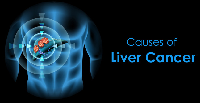 Causes of Liver Cancer- Possible Reasons of This Life Threatening Disease