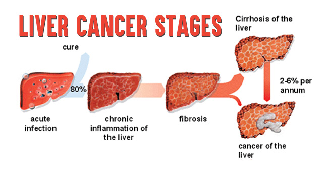 liver-cancer-stages-1.jpg