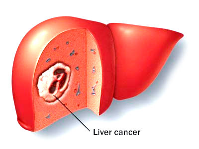 the causes of liver cancer