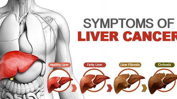 Symptoms of Liver Cancer and Prevention Measures