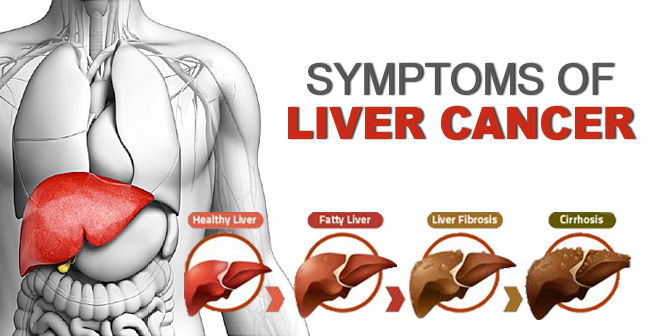 liver cancer symptoms