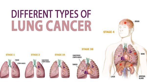 Best Cancer Treatment Hospital in India, Cancer Hospital in Jaipur