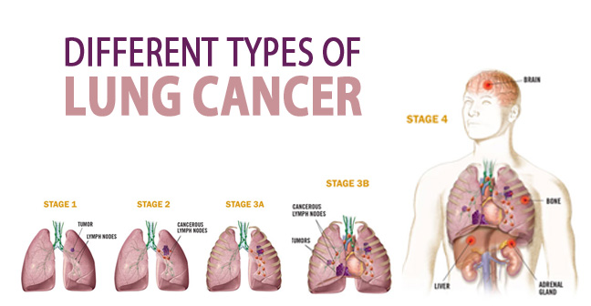 Lung Cancer Types Chart