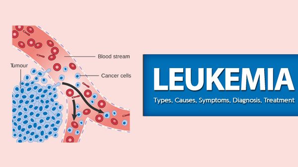 Leukemia – Types, Causes, Symptoms, Diagnosis, Treatment