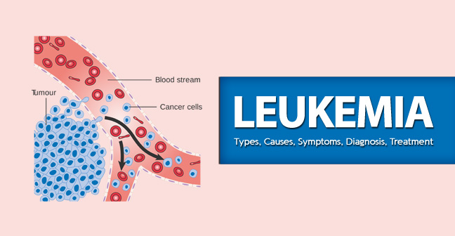 Leukemia – Types, Causes, Symptoms, Diagnosis, Treatment