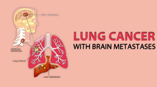 Lung Cancer Brain Metastases – Causes, Symptoms and Treatment Options