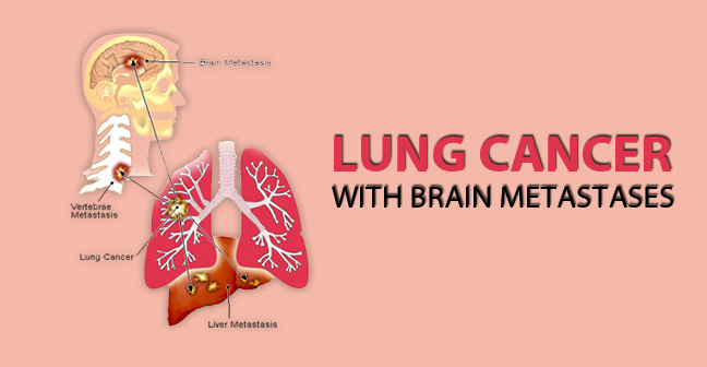 Lung Cancer Brain Metastases - Causes, Symptoms, Life Expectancy, Treatment