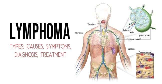 Lymphoma – Types, Causes, Symptoms, Diagnosis, Treatment