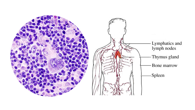 Lymphoma