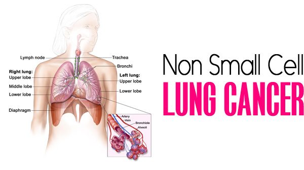 Non-Small Cell lung Cancer – Types, Symptoms, Causes, Stages