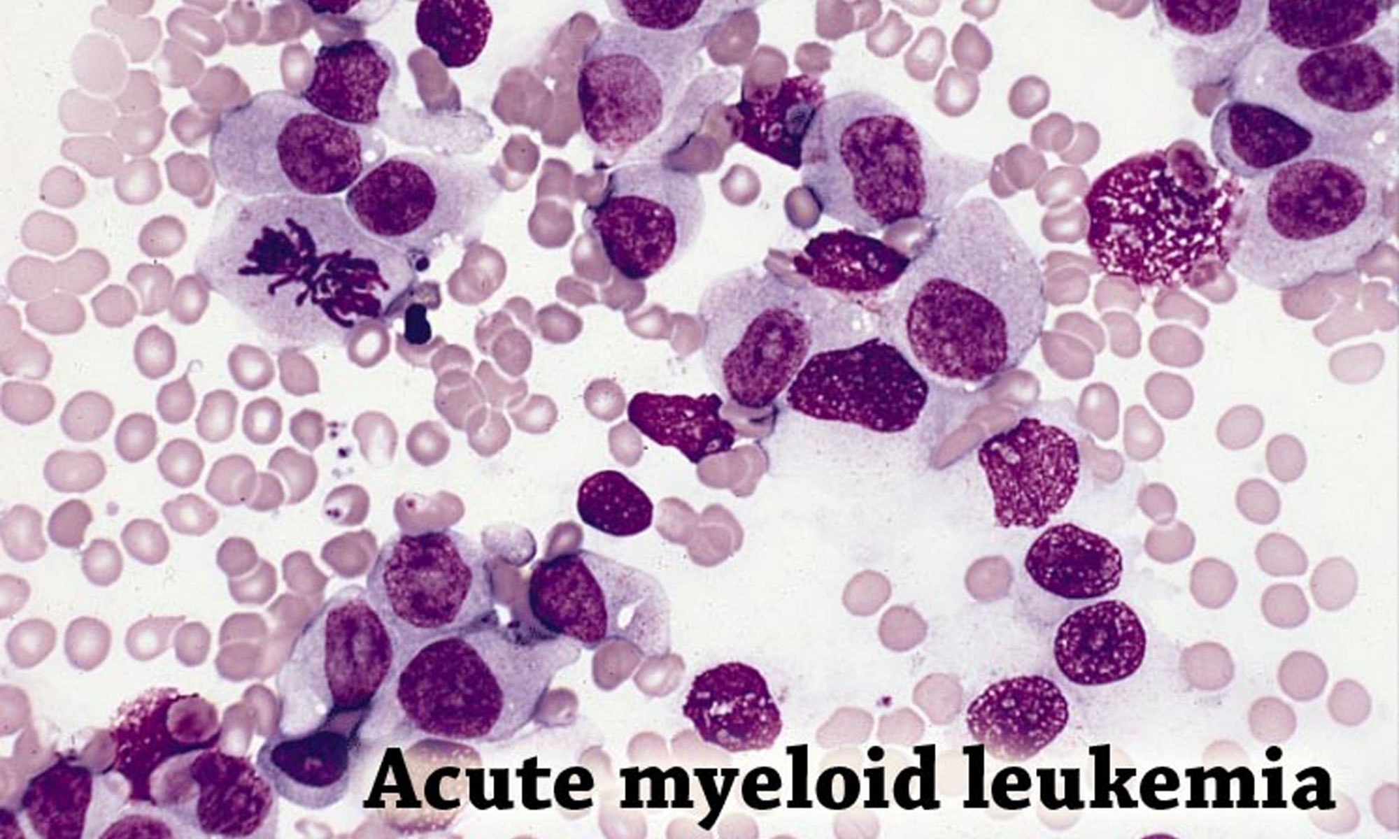 acute-myelogenous-leukemia