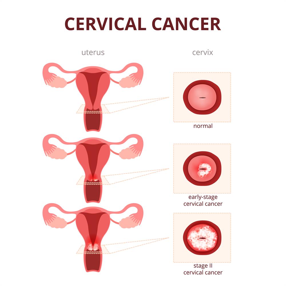 cervical cancer diagnosis