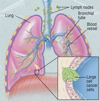 different types of lung cancers