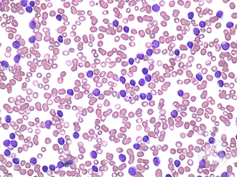 leukemia