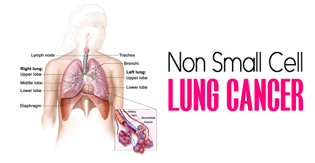 non small cell lung cancer