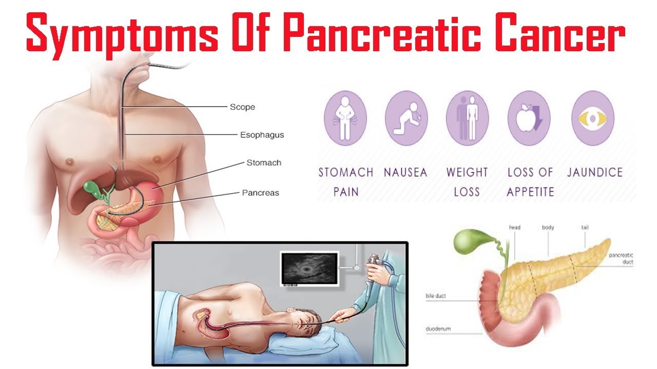 pancreatic cancer symptoms