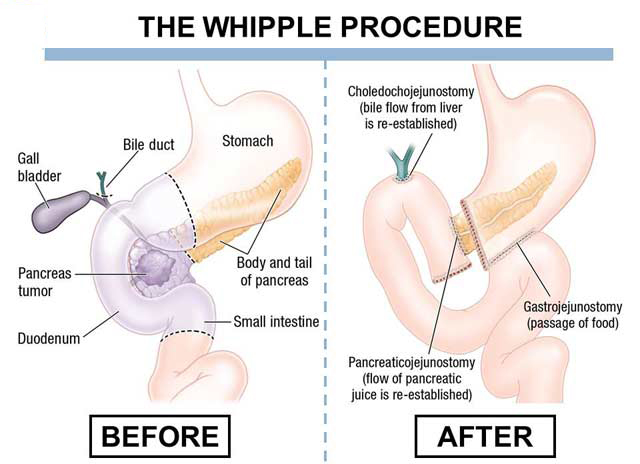 pancreatic cancer treatment options