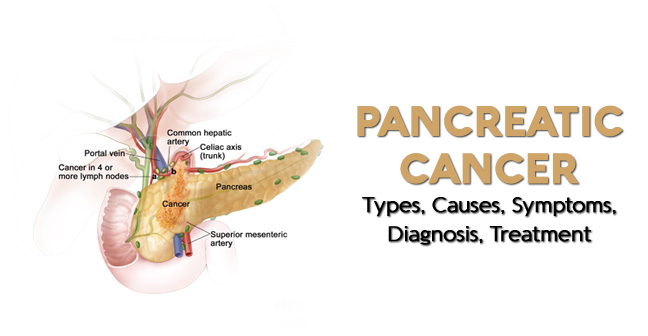 pancreatic cancer