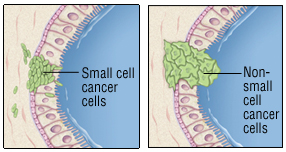 type of lung cancer