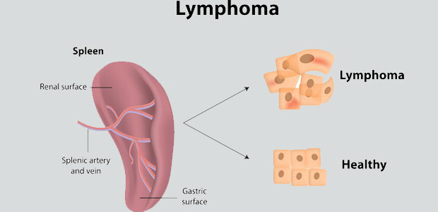 types of blood cancer in adults