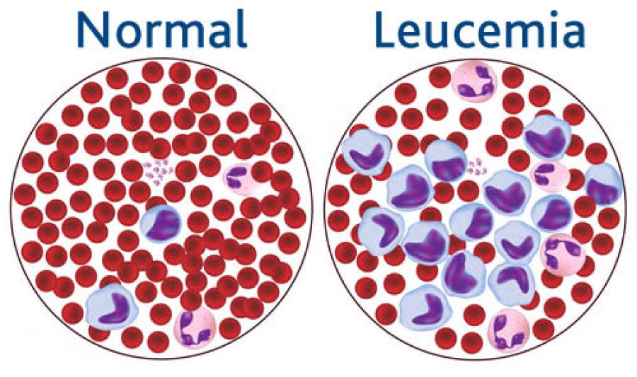 types of blood cancer rare