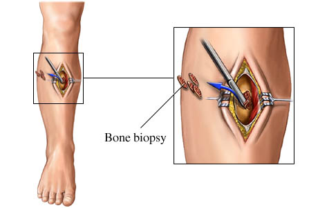 Biopsy for blood cancer