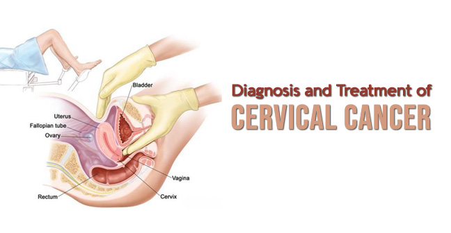 Diagnosis and Treatment of Cervical Cancer