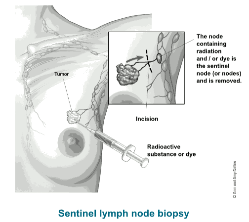 biopsy of lymph node