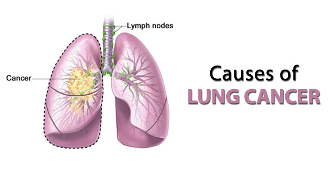 causes of lung cancer