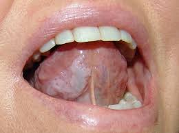 different types of oral cancer