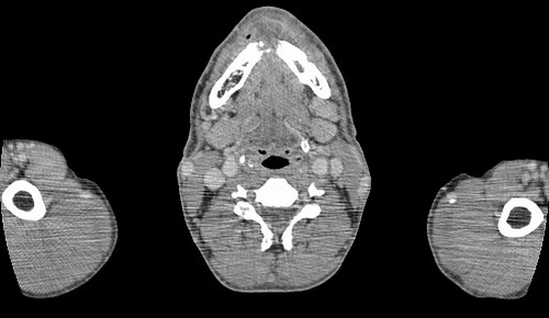 early diagnosis of oral cancer