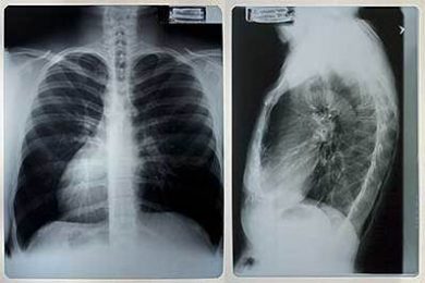 Lung Cancer Diagnosis - Detection Methods for Lung Cancer
