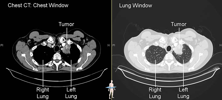 lung cancer diagnosis by stage