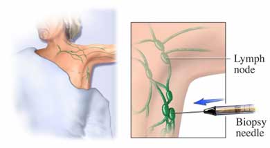 lymph node biopsy