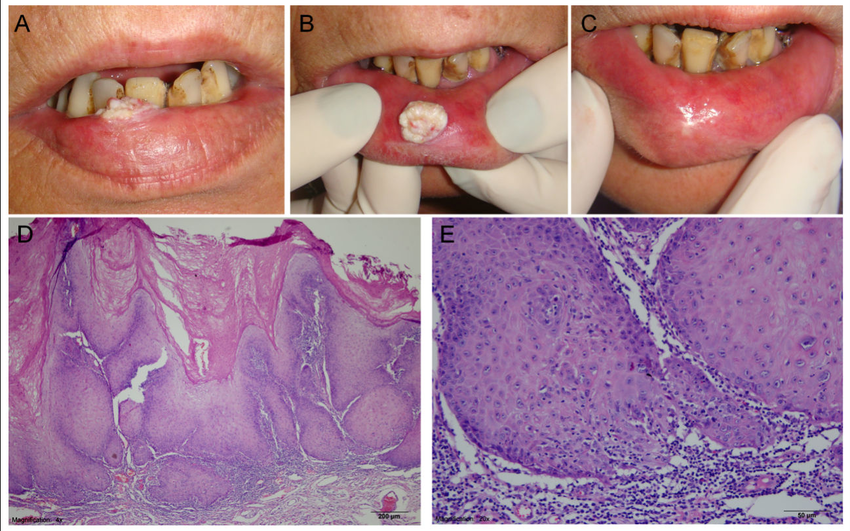 oral cancer types
