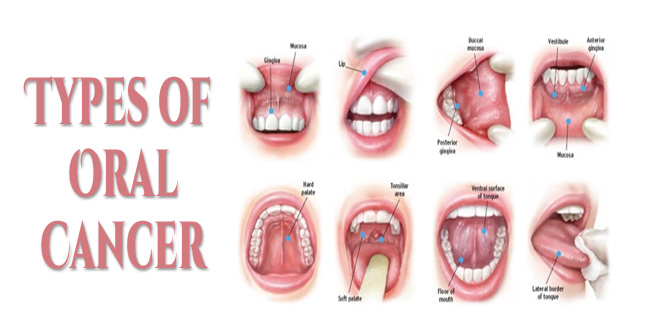 types of orAL CANCER