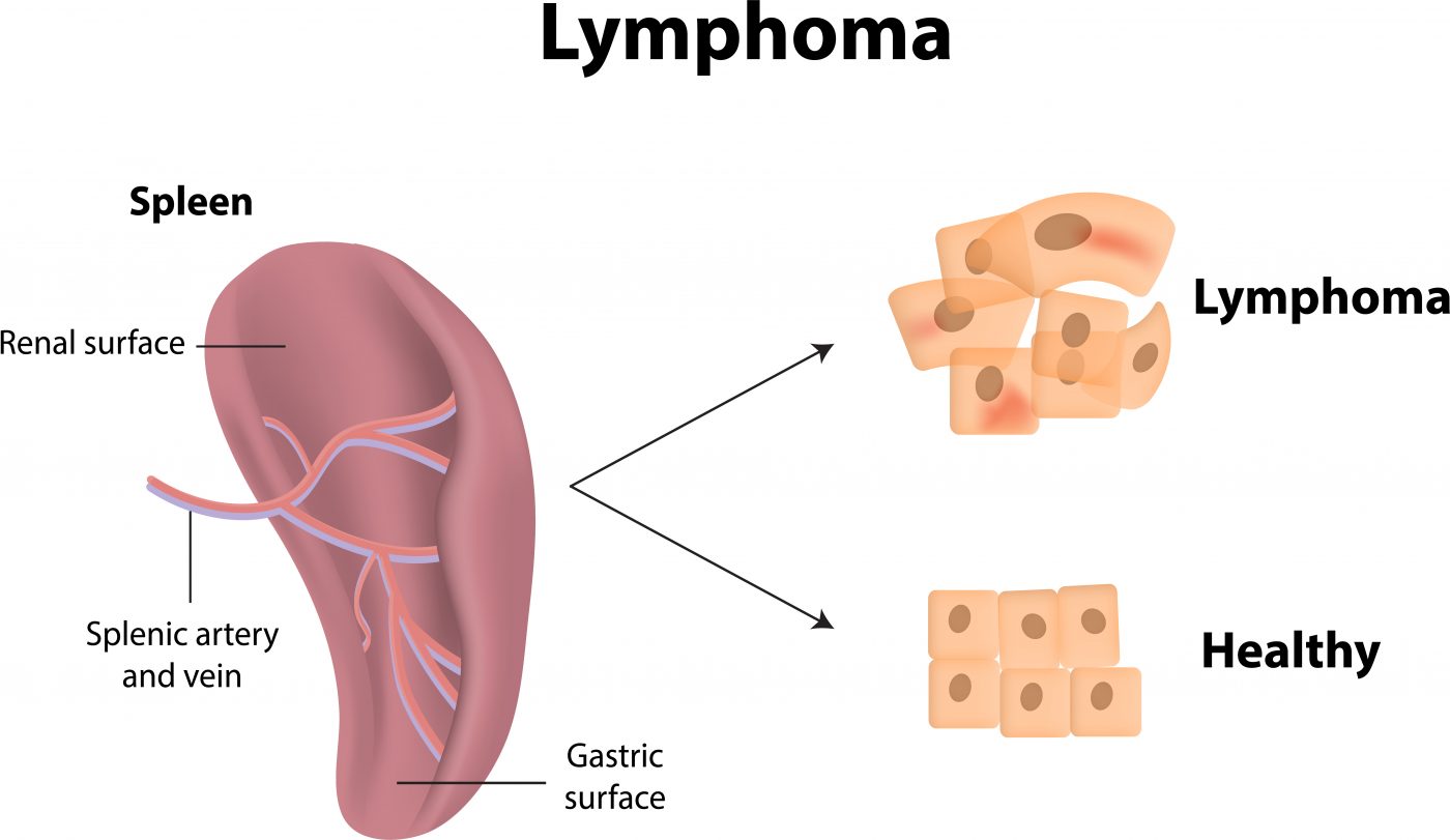types of oral cancer tumors